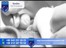 Eurozenhairtransplant-istanbul avrupa